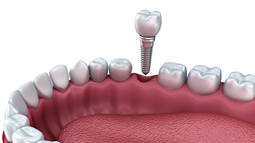 Dental Implants